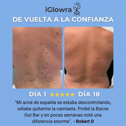 Barra Anti-Acne