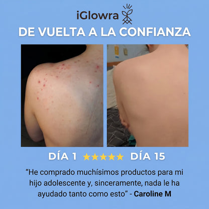 Barra Anti-Acne
